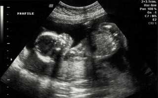 Определение пола ребёнка по УЗИ