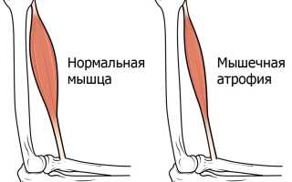 Атрофия – примеры и исследования