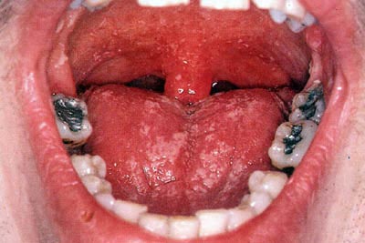 Молочница в ротовой полости Молочница в ротовой полости