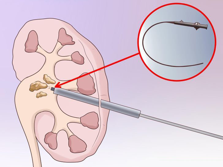 песок в почках