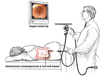 ректороманоскопия
