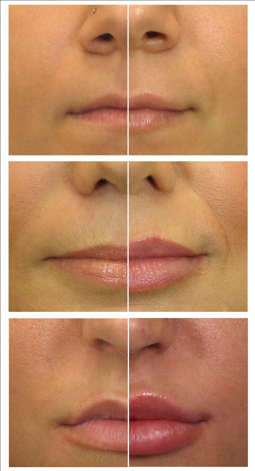 Увеличение губ до и после Увеличение губ до и после